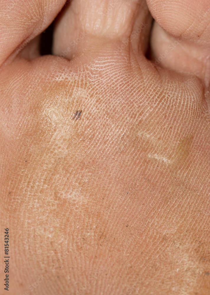 Fototapeta premium rough skin on feet