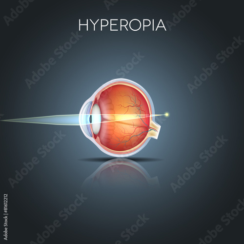 Hyperopia. Hyperopia is being long sighted (far sighted). Near o