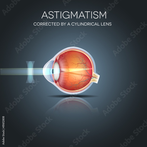 Astigmatism corrected by a cylindrical lens.