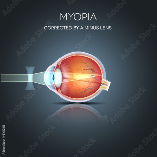Fototapeta Naklejka Na Ścianę i Meble -  Myopia corrected by a minus lens. Myopia is being short sighted