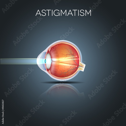 Astigmatism. Eyesight problem, blurred vission. photo