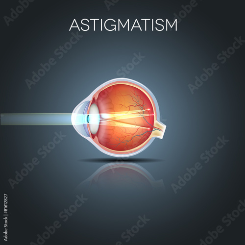 Astigmatism. Eyesight problem, blurred vission.