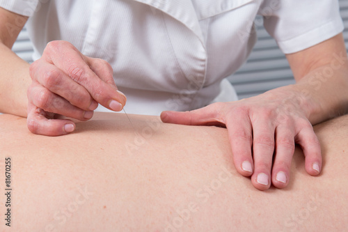 Man Undergoing Acupuncture Treatment