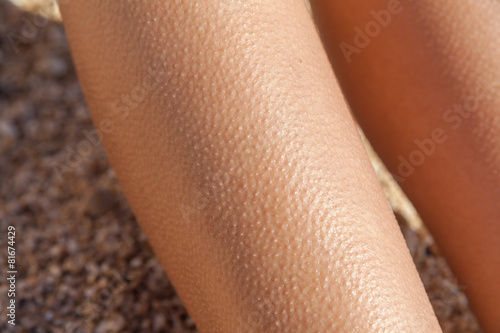 Horripilation from the cold on the legs