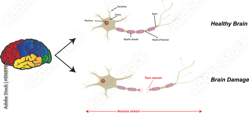 Brain Damage
