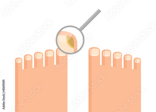 Mycosis on toenail