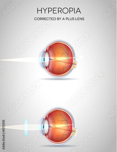 Hyperopia and Hyperopia corrected by a plus lens. Eye vision dis photo