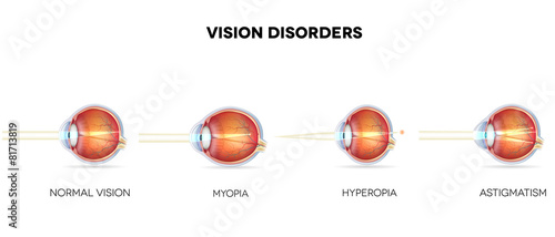 Eyesight disorders. Normal eye, Astigmatism, hyperopia and myopi