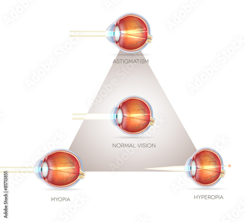 Eye vision triangle, vision disorders. Normal eye, Astigmatism,