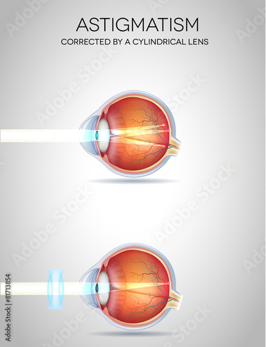 Eye vision disorders. Normal eye, Astigmatism, hyperopia and myo