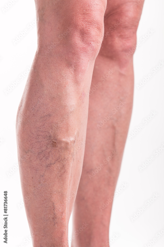 Varicose Veins on the legs of woman Varicose Veins on the legs of woman