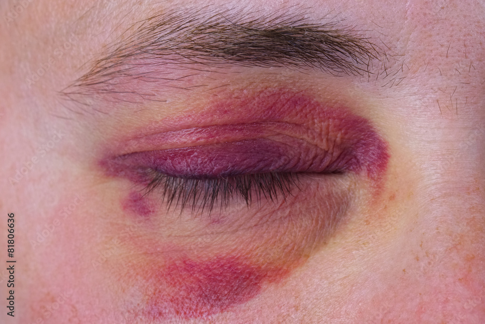 Naklejka premium Human eye with a purple bruise