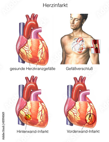 Vorder- und Hinterwandinfarkt.Herz