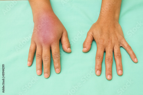 Fototapeta Female hands one swollen and inflamed after accident