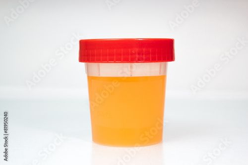 Urine Sample in closed transparent plastic can.