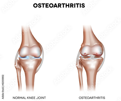 Knee Osteoarthritis isolated on white