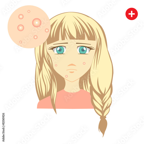 Acne_02