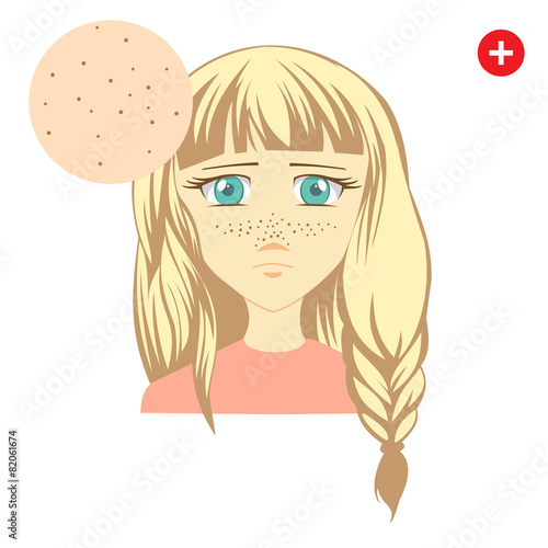 Acne. Problem blackhead