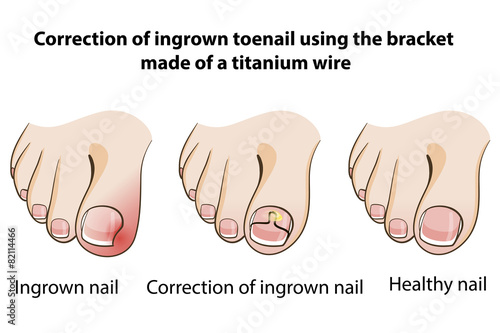 Ingrown toenail