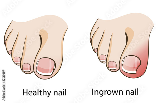 Ingrown nail