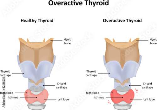 Overactive Thyroid