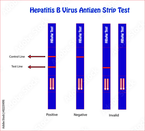 Hepatitis B virus antigen strip test ( HBsAg test)
