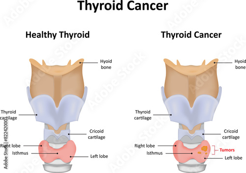 Thyroid Cancer photo