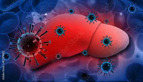 Liver Infection with hepatitis viruses.