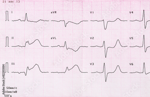 Canvas Print Tape ECG with acute period of myocardial infarction
