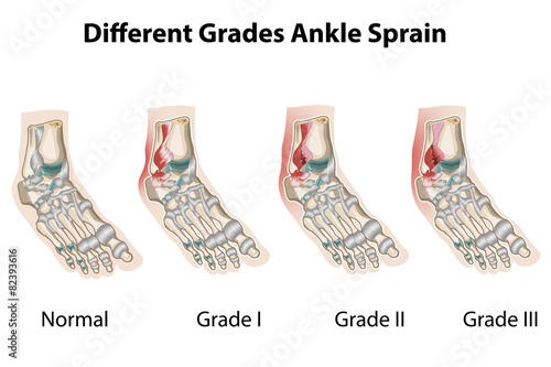 ankle sprains