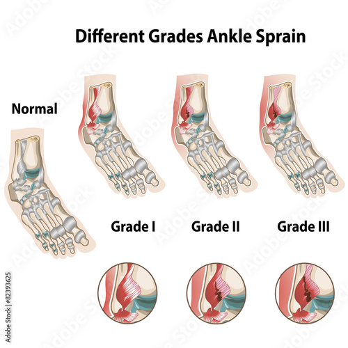 Grades of ankle sprains