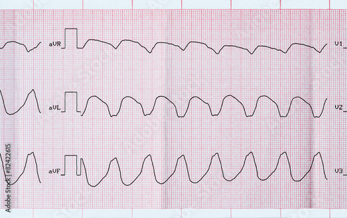 Fotografía ECG tape with paroxysmal ventricular tachycardia