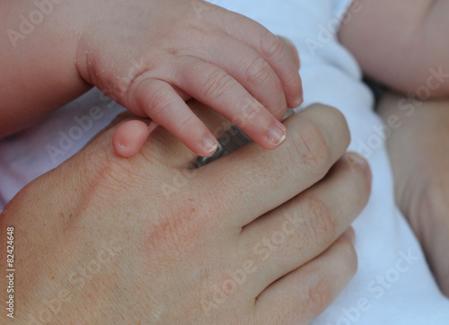 mild form of polydactyly on hand of newborn