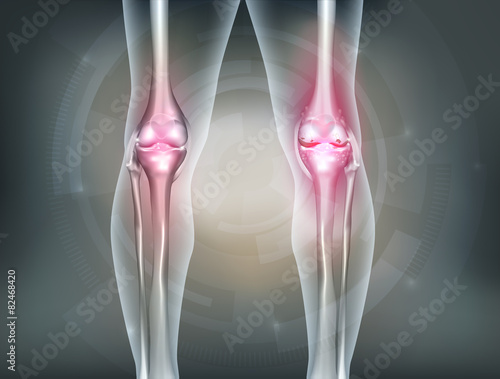 Human legs and knee joint detailed anatomy, painful joint