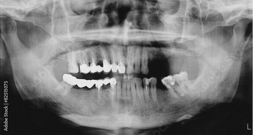 Panoramic x-ray of the mouth