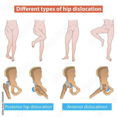 Hip dislocation