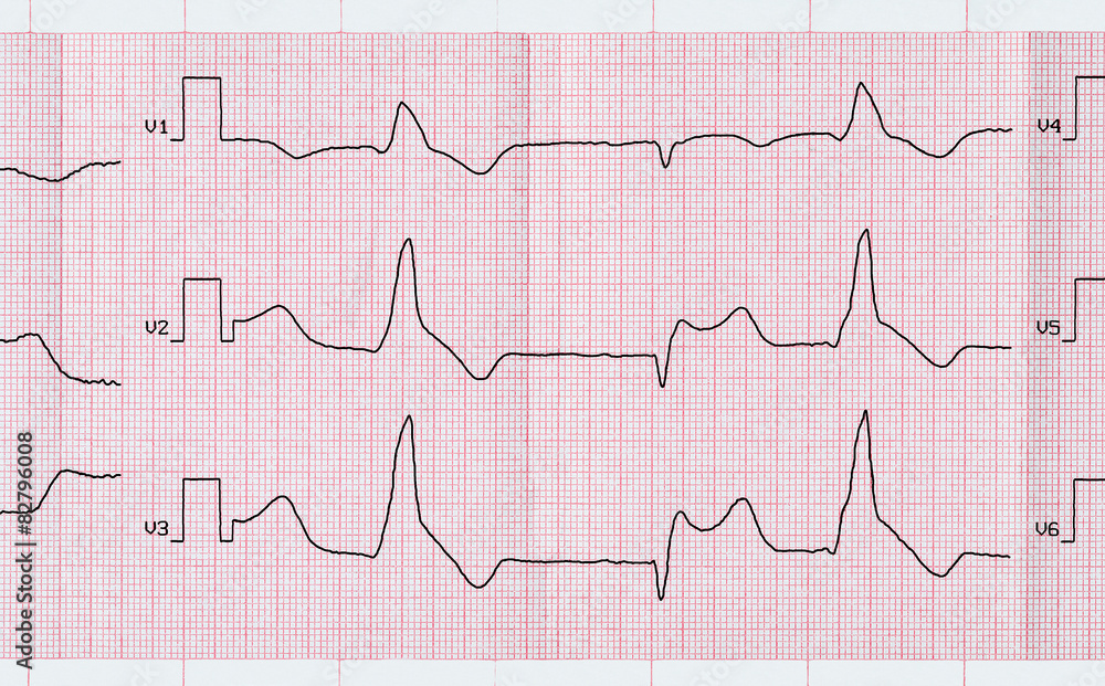 Tape ECG with macrofocal myocardial infarction and ventricular p