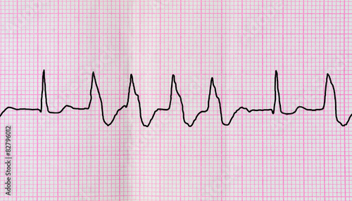 Tape ECG with group ventricular extrasystoles