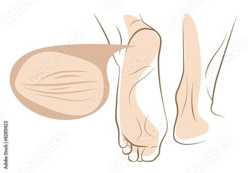 Concept of dry and cracked skin on woman foot