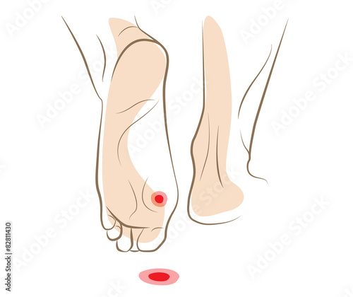 Concept of callus or plantar wart under foot