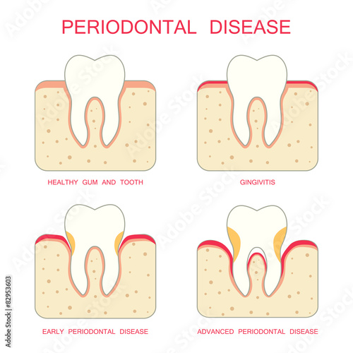 tooth periodontal disease, dental gum  periodontists