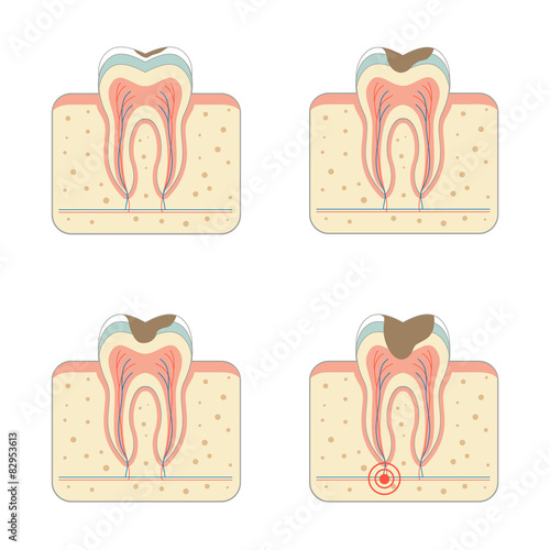 tooth decay disease, dental root tinfection