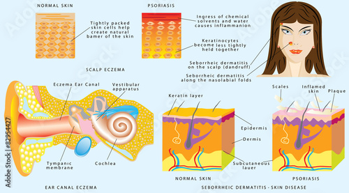 Eczema skin