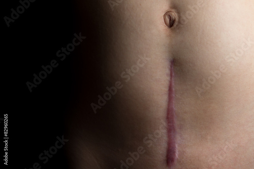 Recovering C-Section Scar