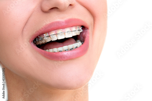 Teeth with Braces. Closeup Ceramic and Metal Braces.