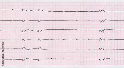  ECG with single ventricular complexes and ventricular asystole