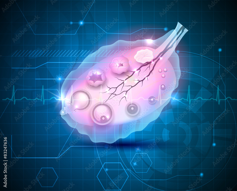 Amazing Ovarian Mesothelioma Capture Art Amazing Ovarian Mesothelioma Capture Art