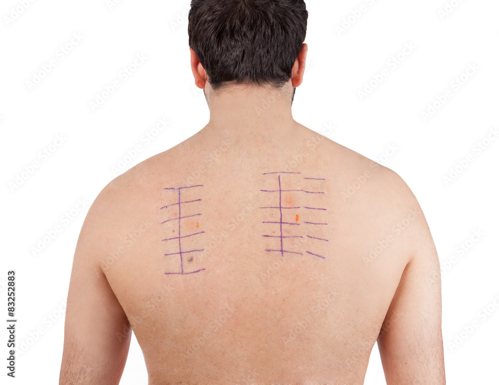 Naklejka premium Skin Allergy Patch Test on Back