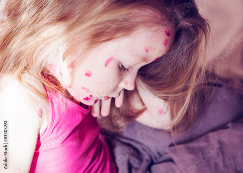 Obraz na plátně The girl is suffering from chicken pox