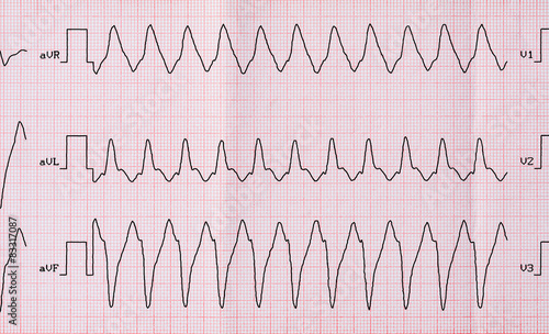 Fotografie ECG with paroxysm correct form of atrial flutter